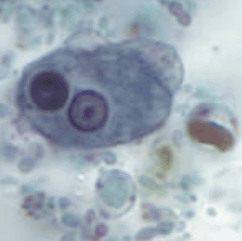 Imagen: Un trofozoito de Entamoeba histolytica (Fotografía cortesía de los Centros para el Control y Prevención de las Enfermedades).